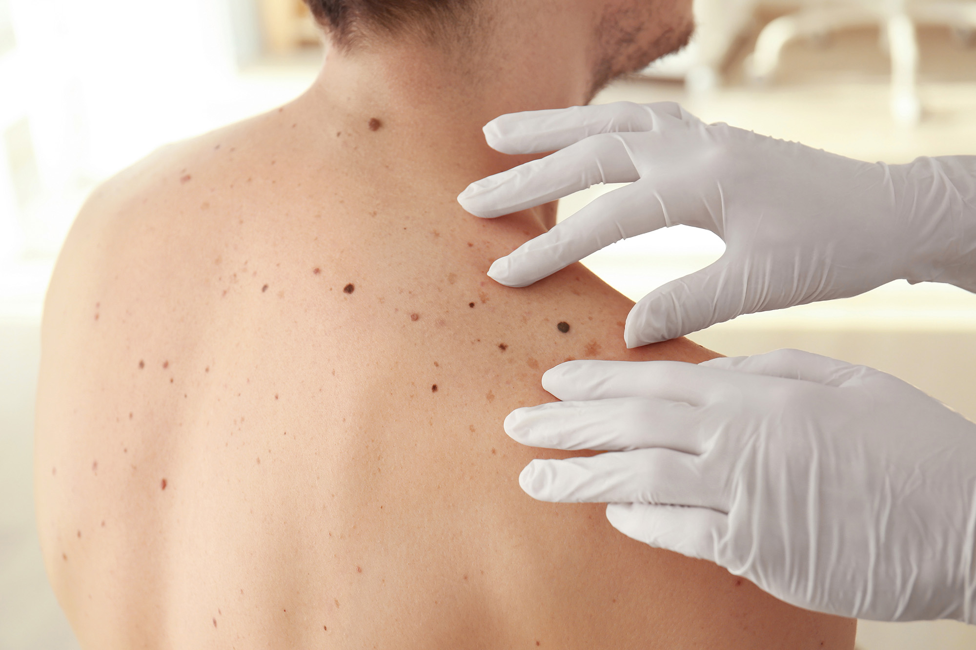 photo of moles on a person's back being checked by a health professional